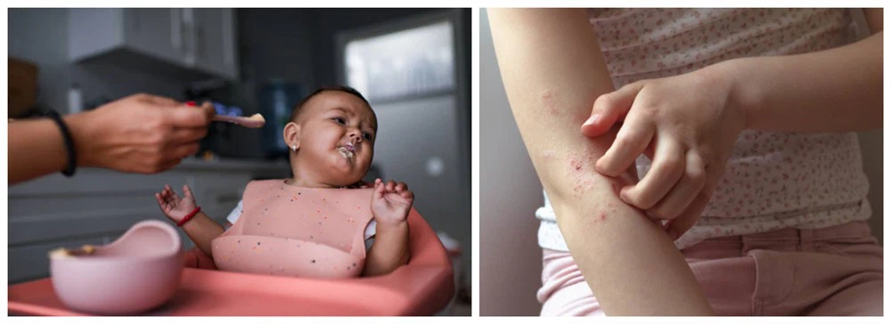 Allergic reactions in infants and young children Allergic reactions in infants and young children